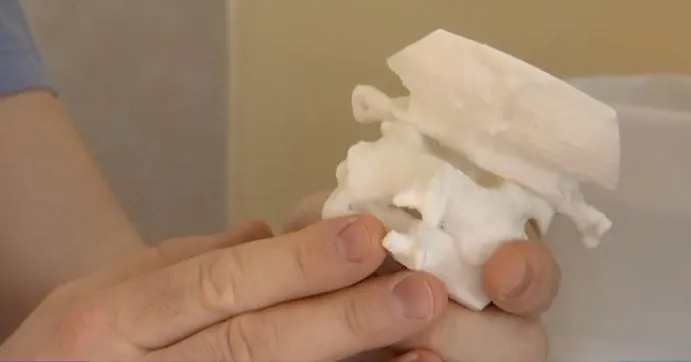 Гомельские нейрохирурги провели операцию с напечатанным на 3D-принтере позвоночником