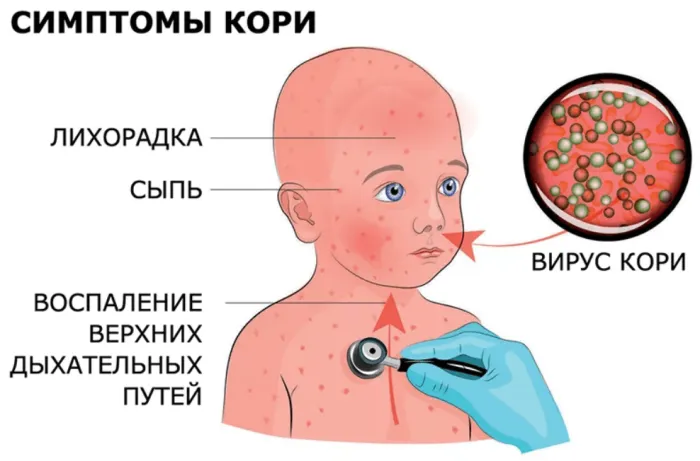 Корь. Меры профилактики