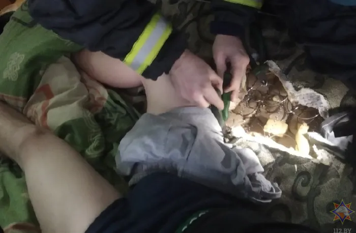 В Мозыре спасатели помогли молодому человеку, которому пружина матраса вонзилась в ногу