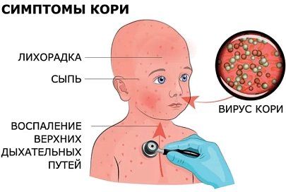 Корь. Меры профилактики