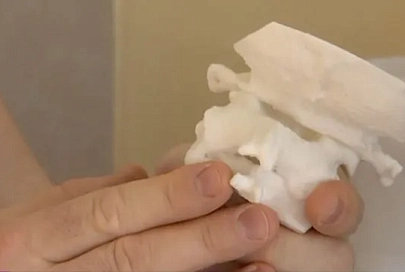Гомельские нейрохирурги провели операцию с напечатанным на 3D-принтере позвоночником